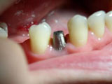 Dental implant being placed